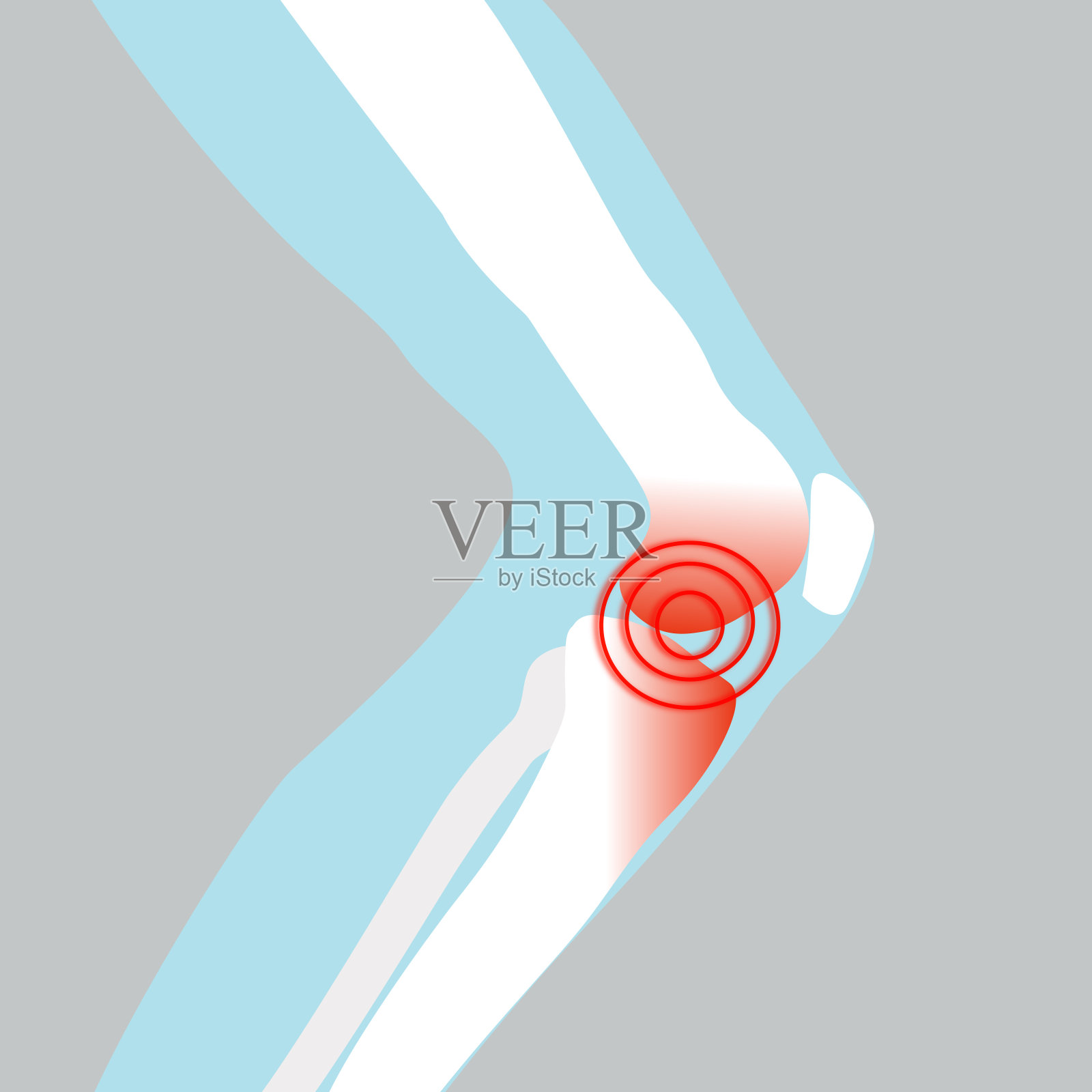 对人体膝盖的伤害。半月板、关节炎插画图片素材