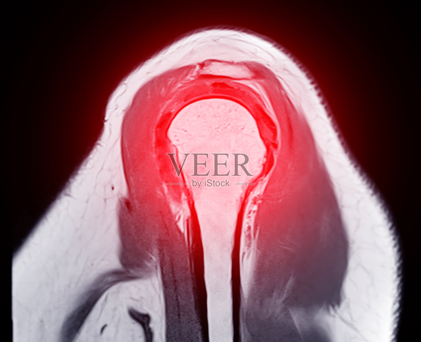 肩关节磁共振成像或MRI诊断肩关节疼痛。照片摄影图片