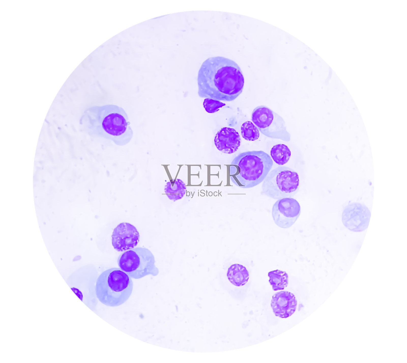 多发性骨髓瘤,又称骨髓瘤,是骨髓癌的一种。照片摄影图片