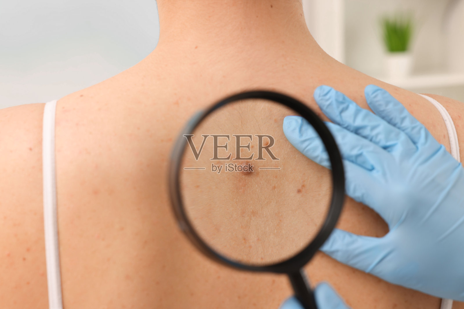 皮肤科医生在室内用放大镜检查病人的胎记,特写照片摄影图片