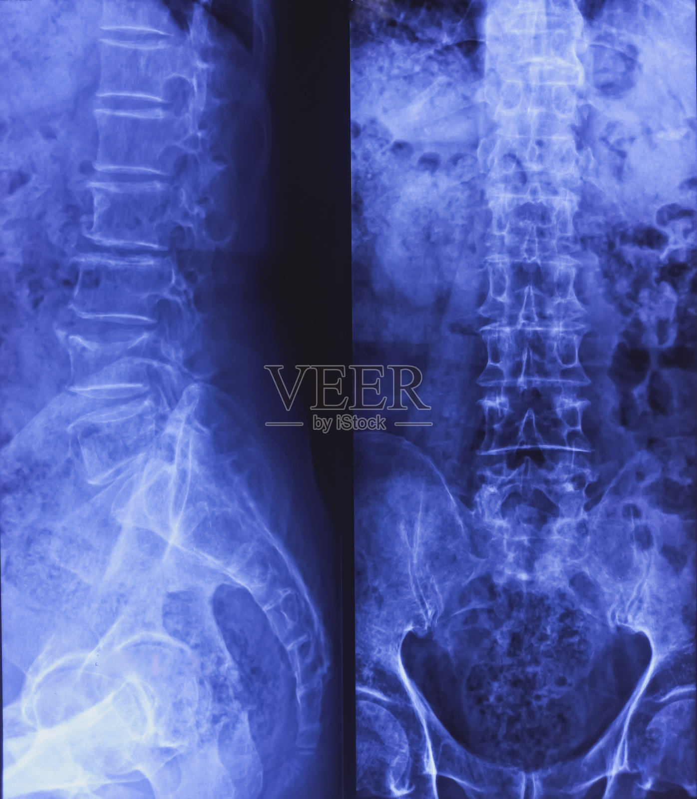 腰骶(LS)脊柱x线双视图。矫正木材前凸弯曲。腰椎的退行性改变。L4椎体部分受压塌陷。照片摄影图片