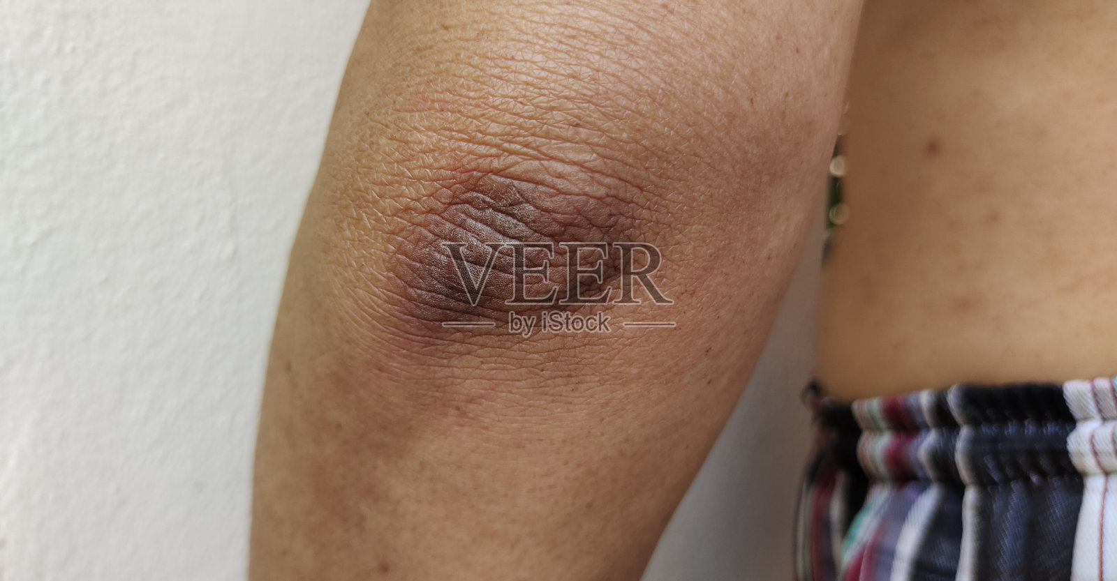 黑肘。照片摄影图片