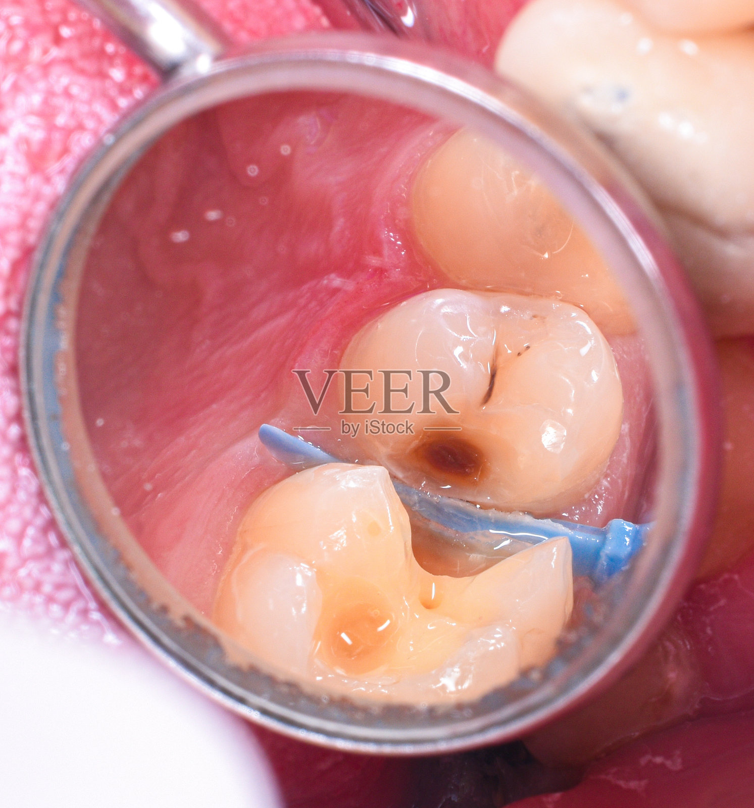 治疗前的蛀牙及蛀牙图片照片摄影图片