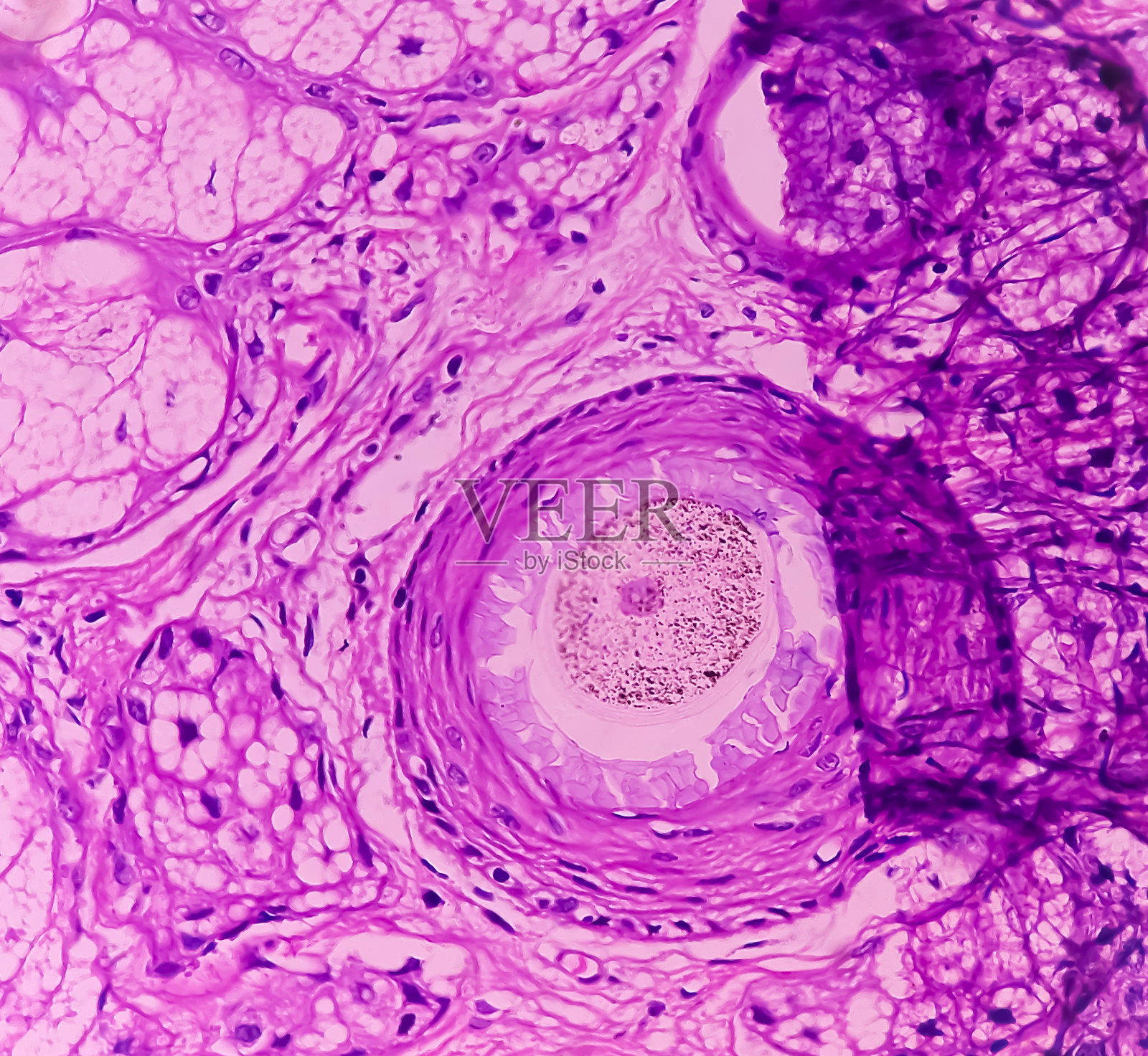 成熟囊性畸胎瘤,卵巢囊肿活检,显示皮肤和附件结构,脂肪组织,唾液腺泡和软骨囊肿壁。皮样囊肿的囊性畸胎瘤。照片摄影图片