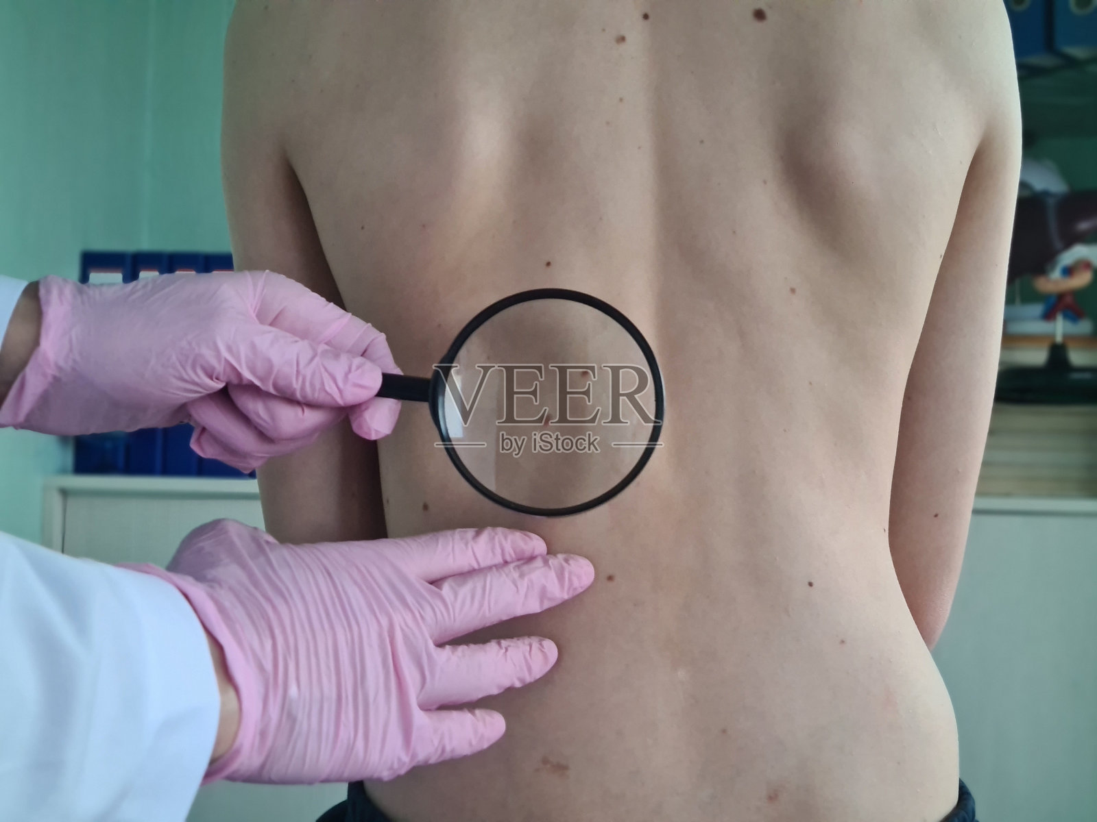 皮肤科医生用放大镜检查背部的痣照片摄影图片