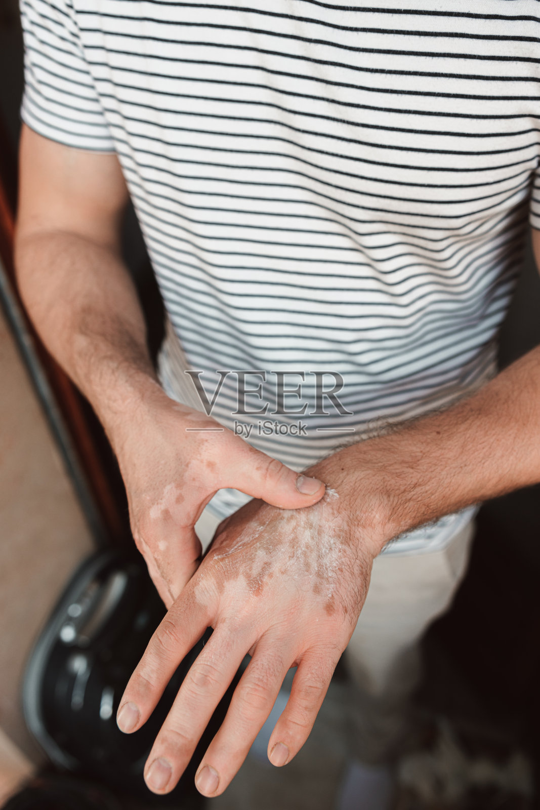 治疗手上的白癜风疾病照片摄影图片