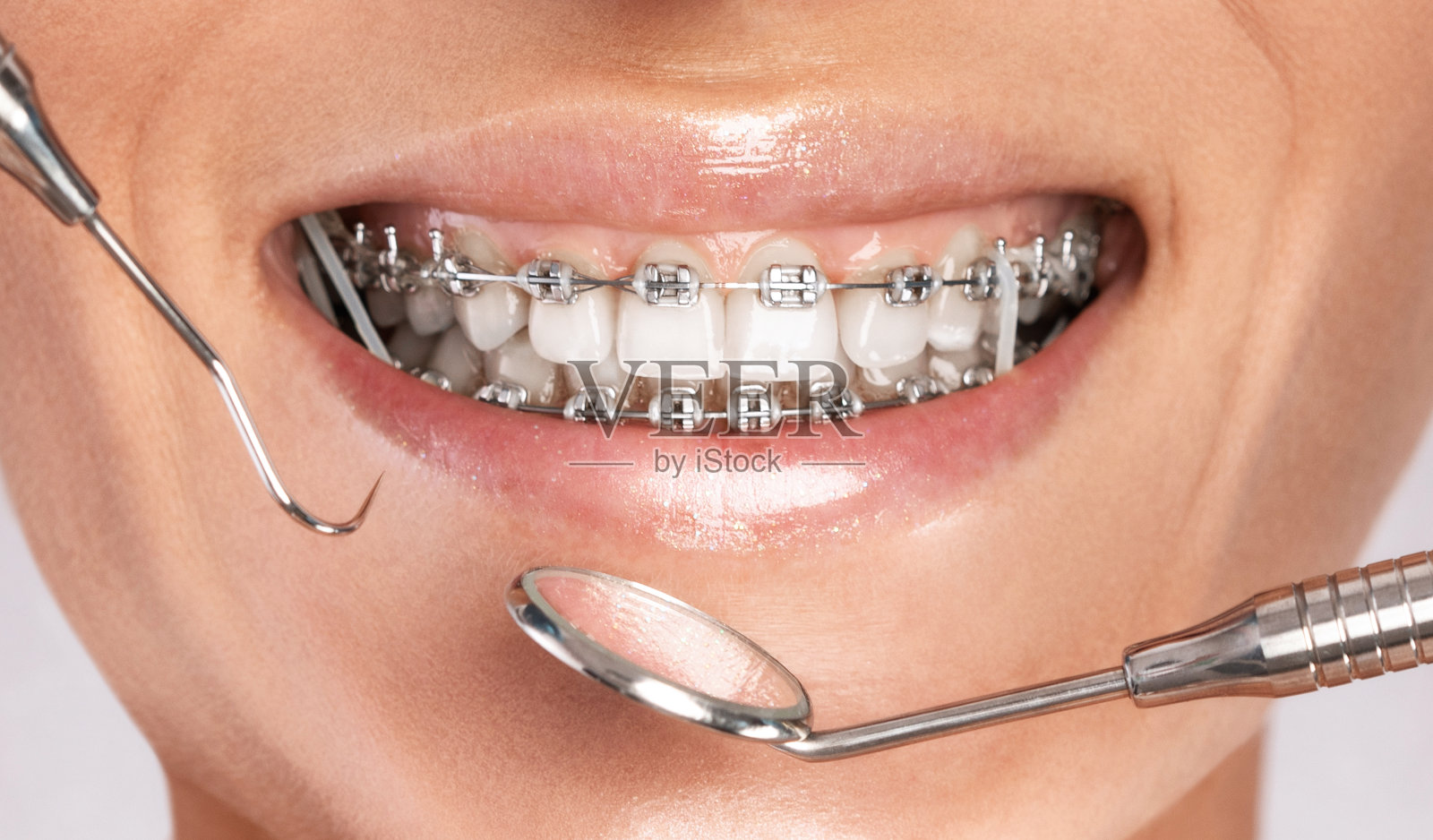 牙科诊所里,牙医正在检查一位年轻漂亮女子牙齿上的牙套。矫正错牙合。照片摄影图片