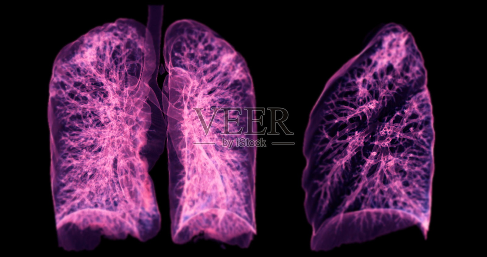 CT胸部3D扫描显示右上肺叶病变,提供了详细的可视化,有助于精确识别和治疗计划。照片摄影图片