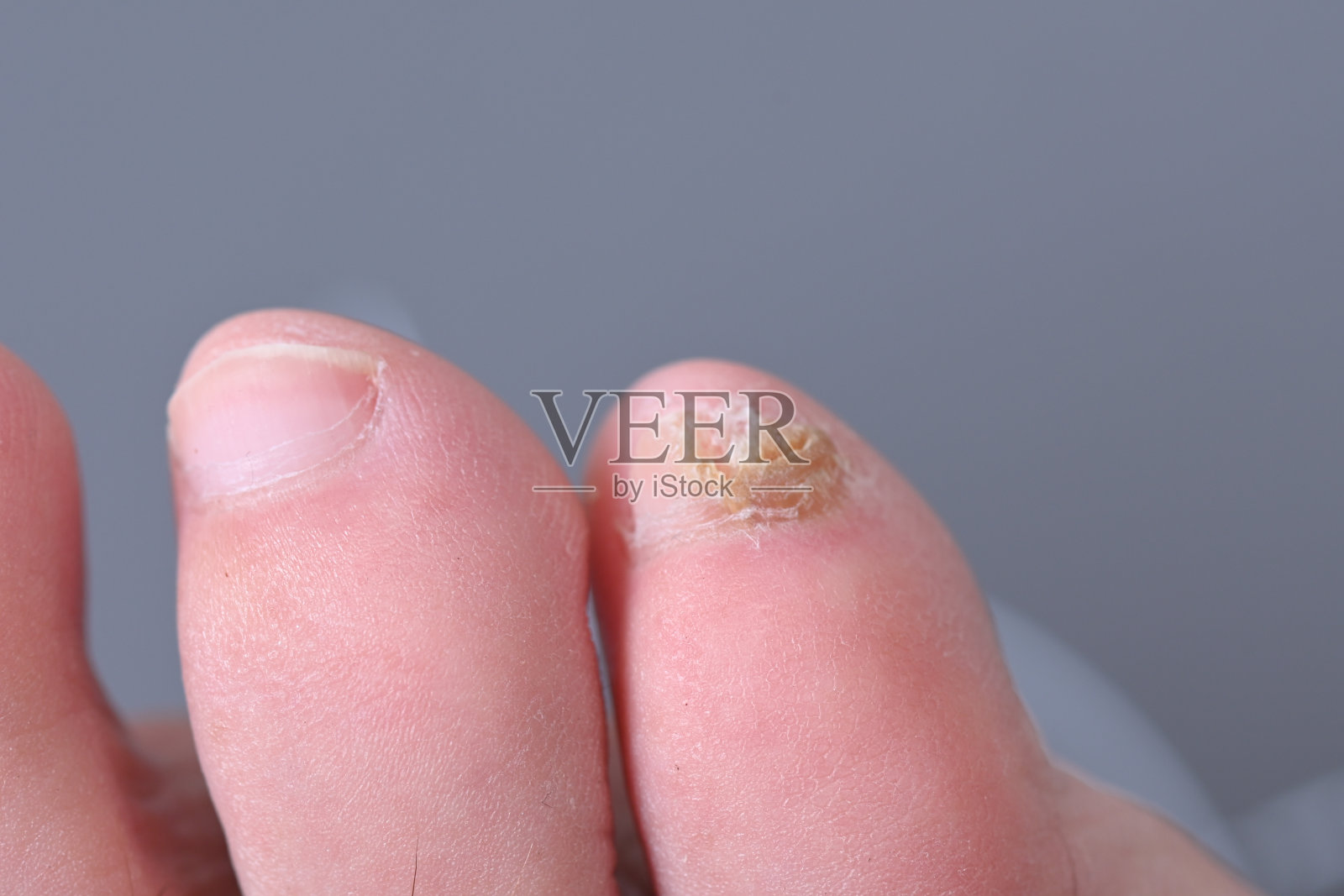 真菌病大趾甲的真菌感染。脚趾甲真菌感染伴癣癣、甲真菌病、热干性皮肤感染病的结果照片摄影图片