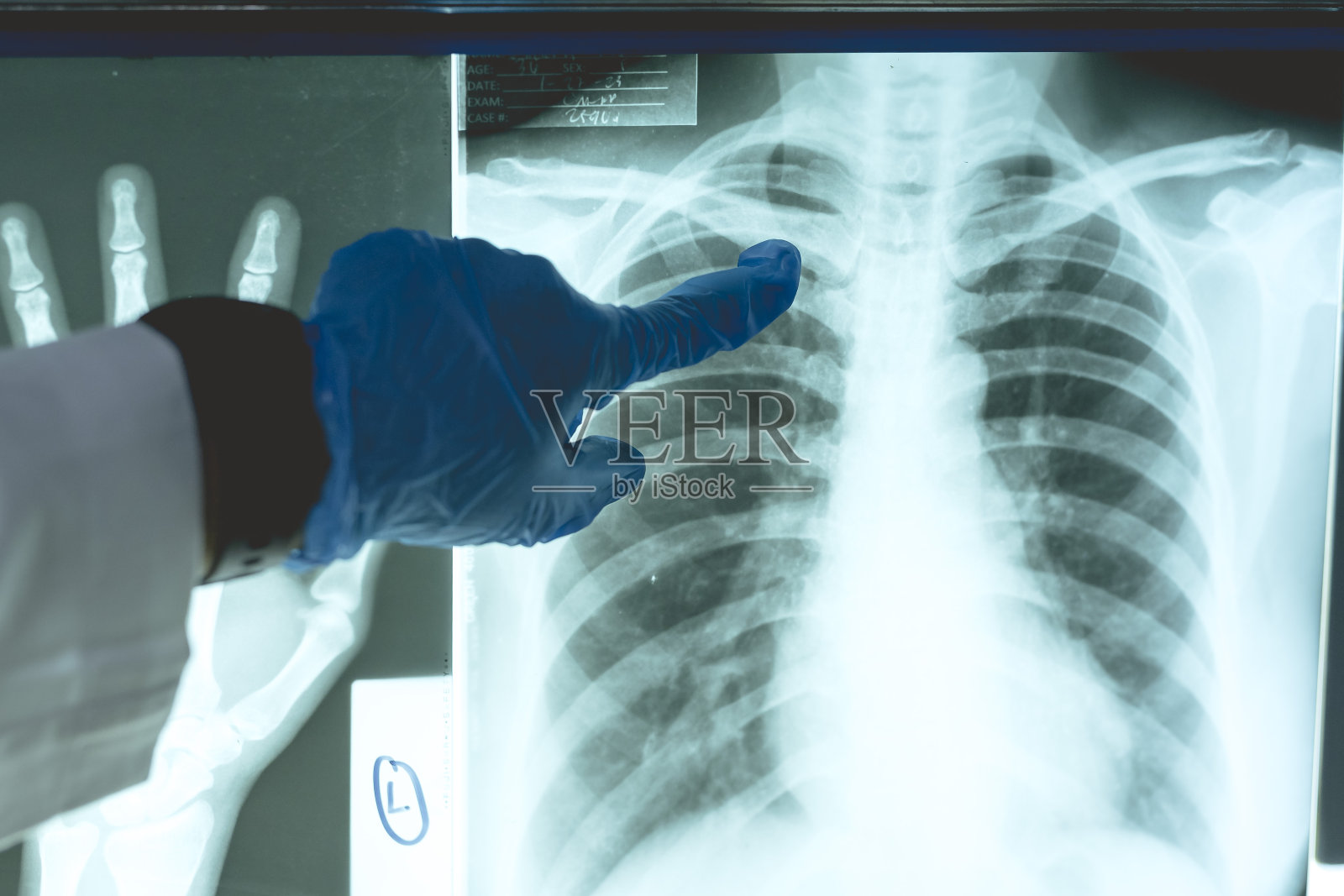 一位女放射科医生正在检查病人肋骨的x光片,看是否有可能出现发际骨折。传统的x光片。照片摄影图片