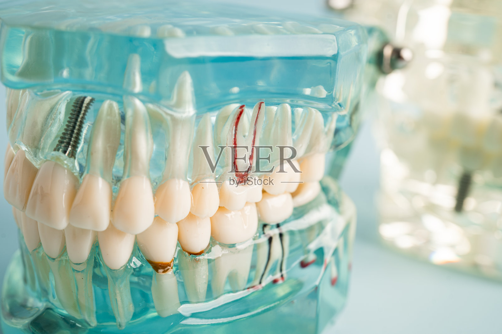 下颌人工牙根种植体,牙医根管模型。照片摄影图片