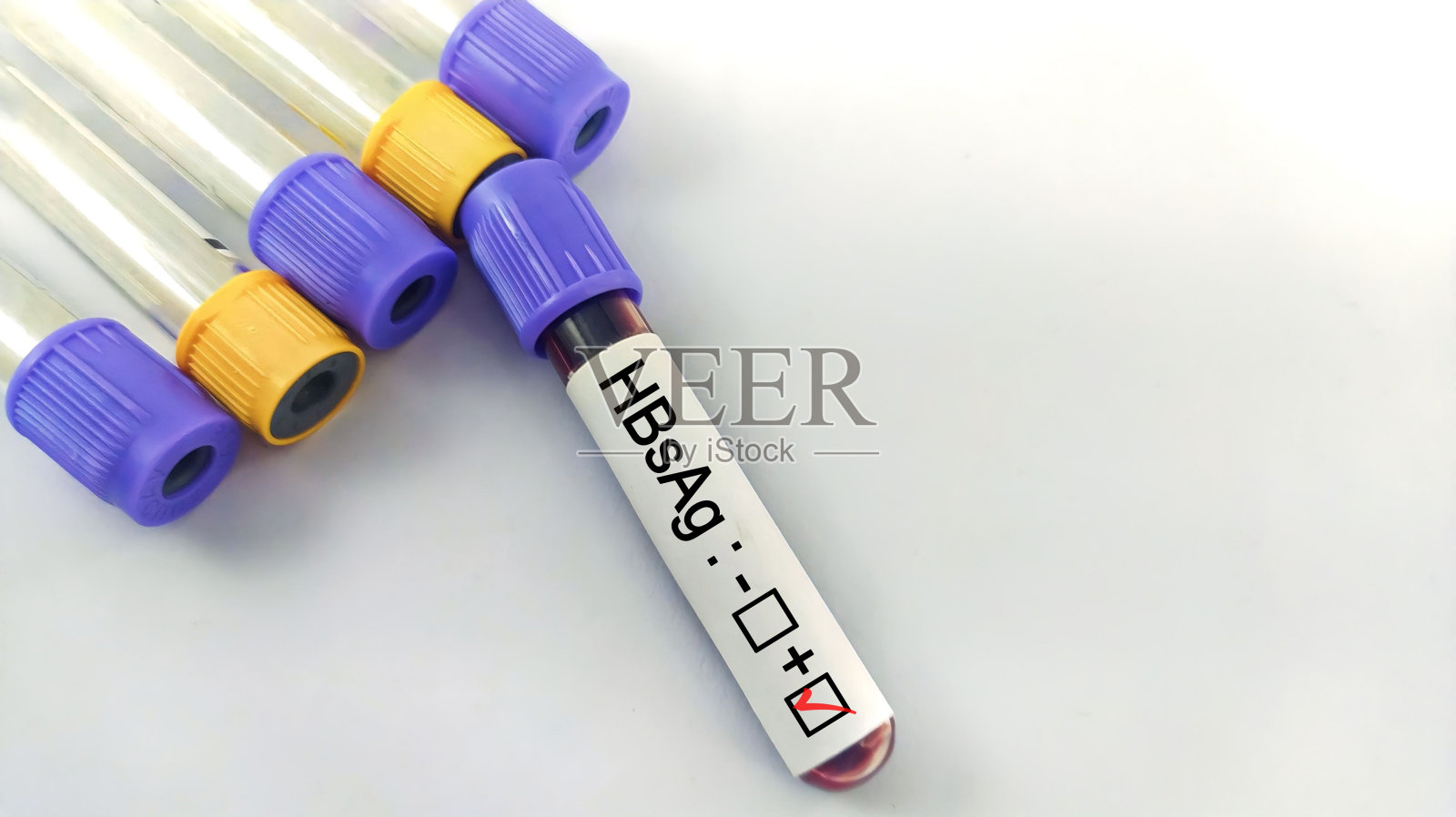 乙型肝炎表面抗原检测阳性,诊断为乙型肝炎照片摄影图片