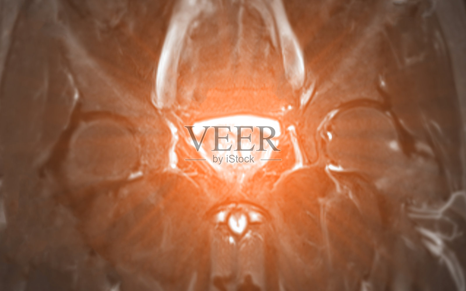 前列腺核磁共振成像,显示前列腺肿大。照片摄影图片