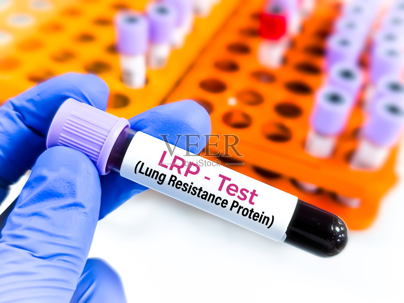 采血进行肺抵抗蛋白(LRP)试验,诊断慢性髓性白血病(CML)。照片摄影图片