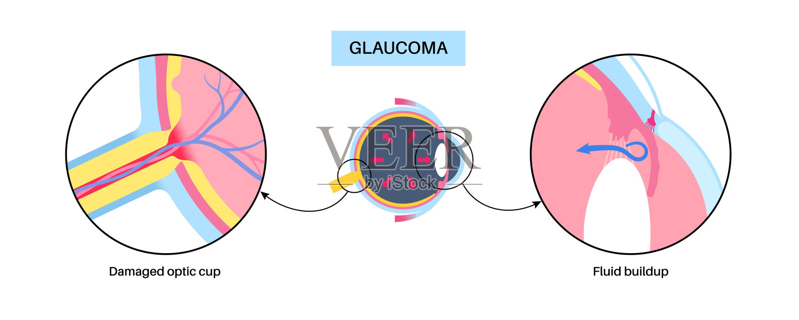 青光眼眼病插画图片素材
