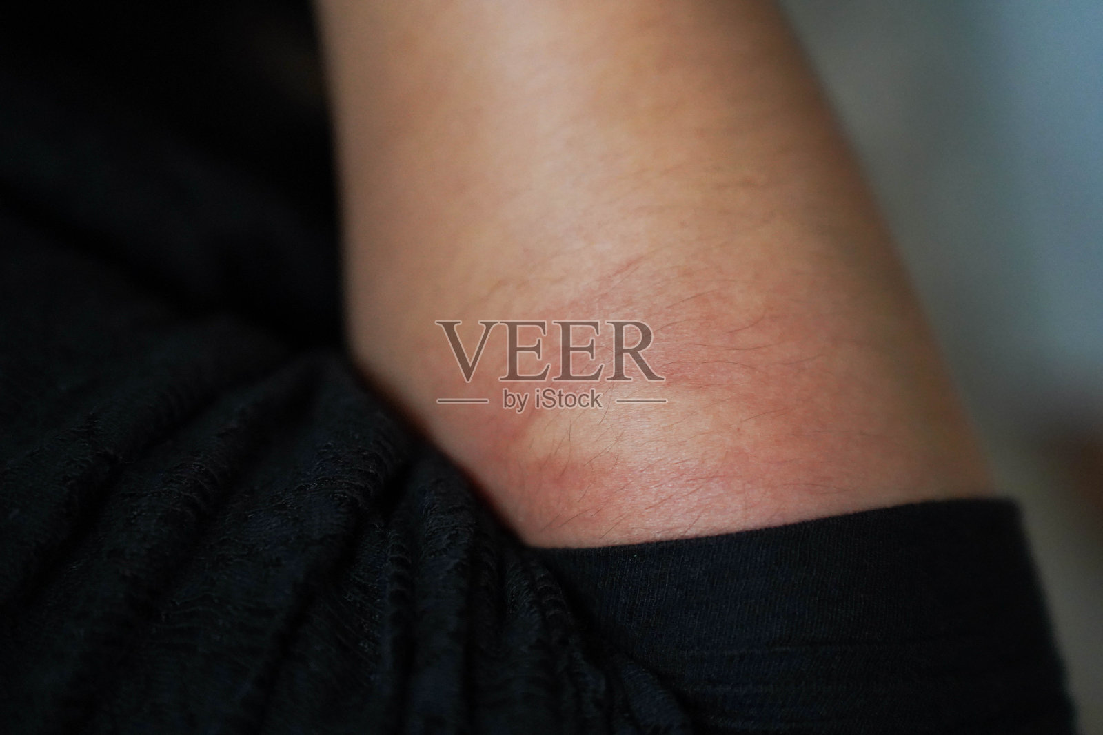 对蚊子叮咬有过敏反应照片摄影图片