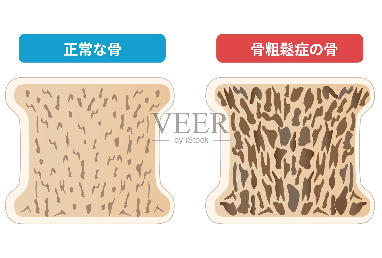 骨质疏松与正常骨的横切面比较插画图片素材