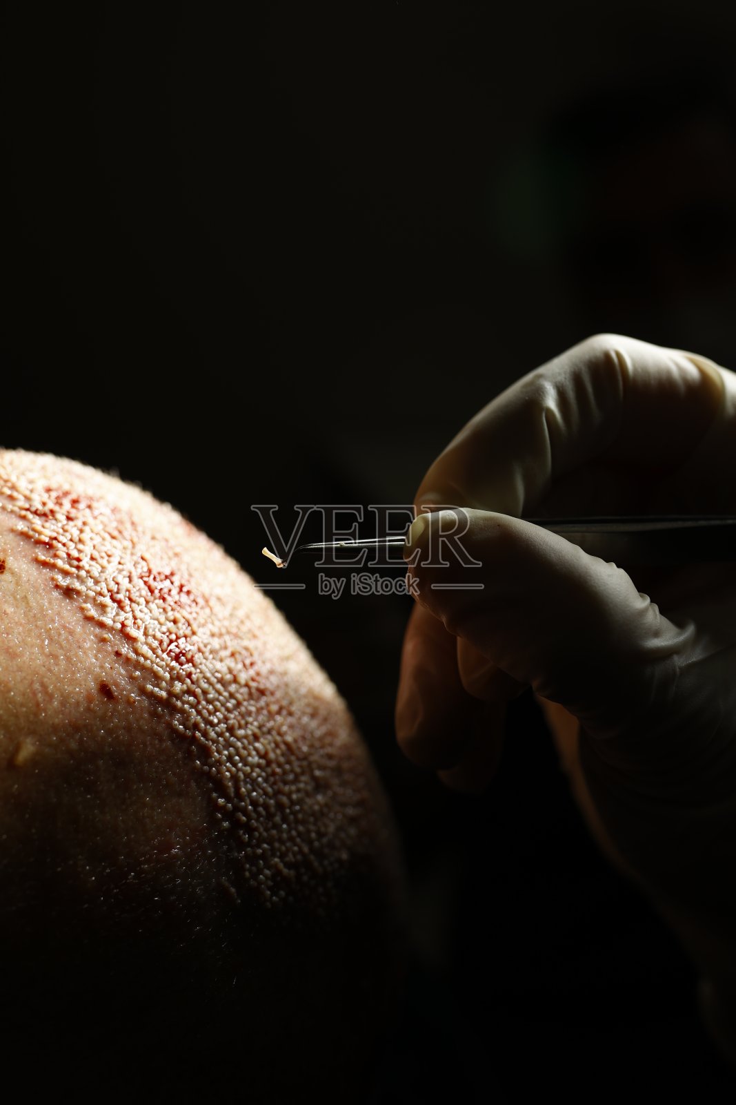 植发DHI照片摄影图片