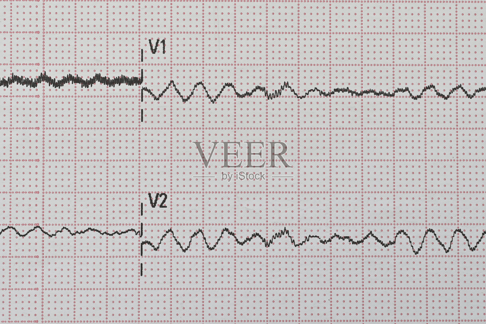 心室纤维性颤动照片摄影图片