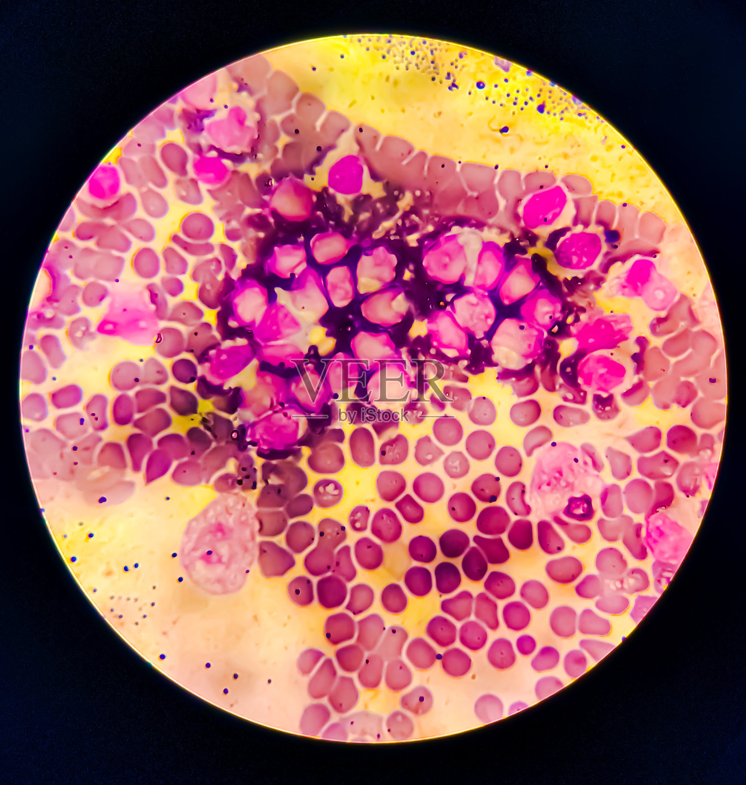 急性白血病,ALL(急性淋巴细胞白血病)照片摄影图片