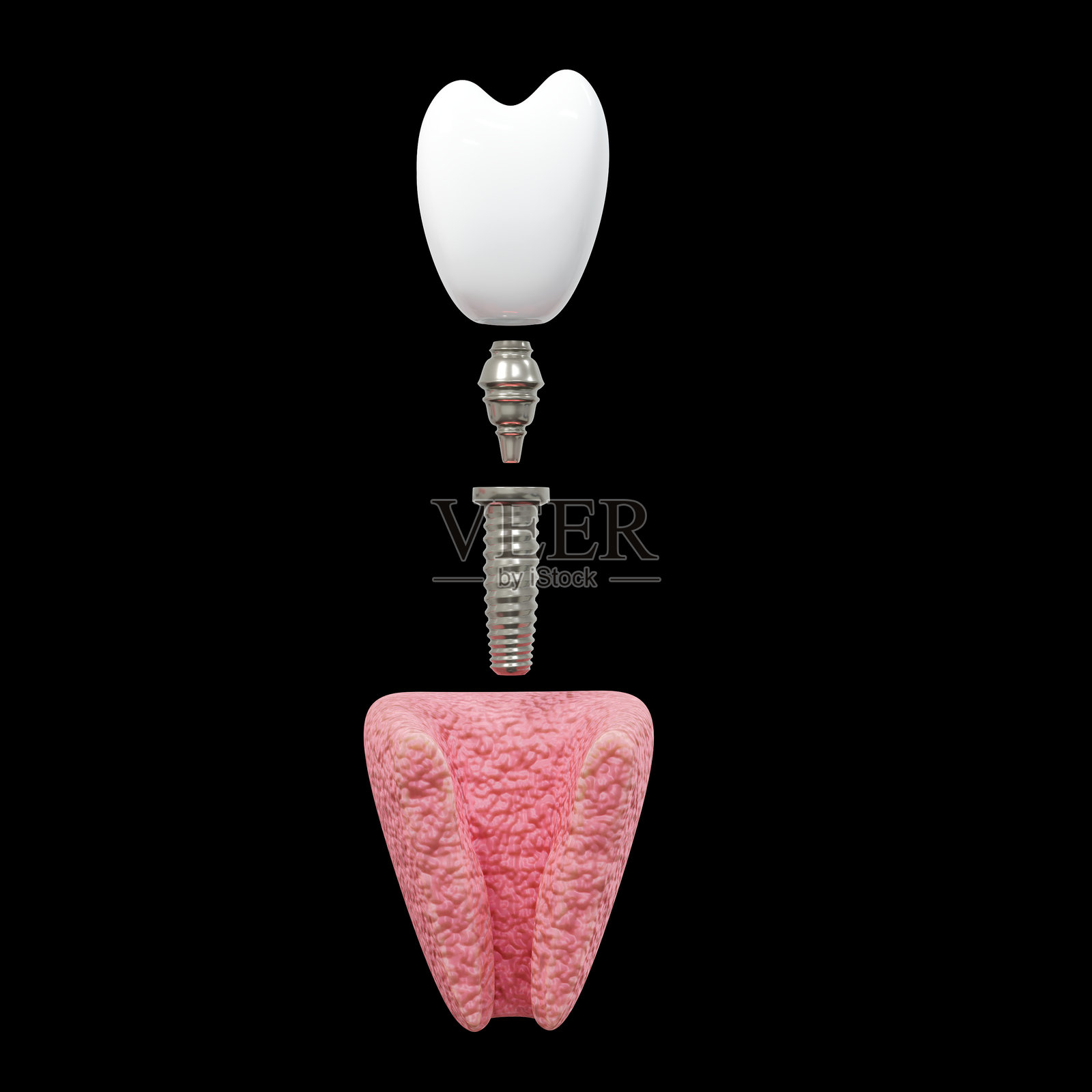 牙科植牙手术概念,牙科假牙,黑色背景上的牙科假牙。3D渲染。照片摄影图片