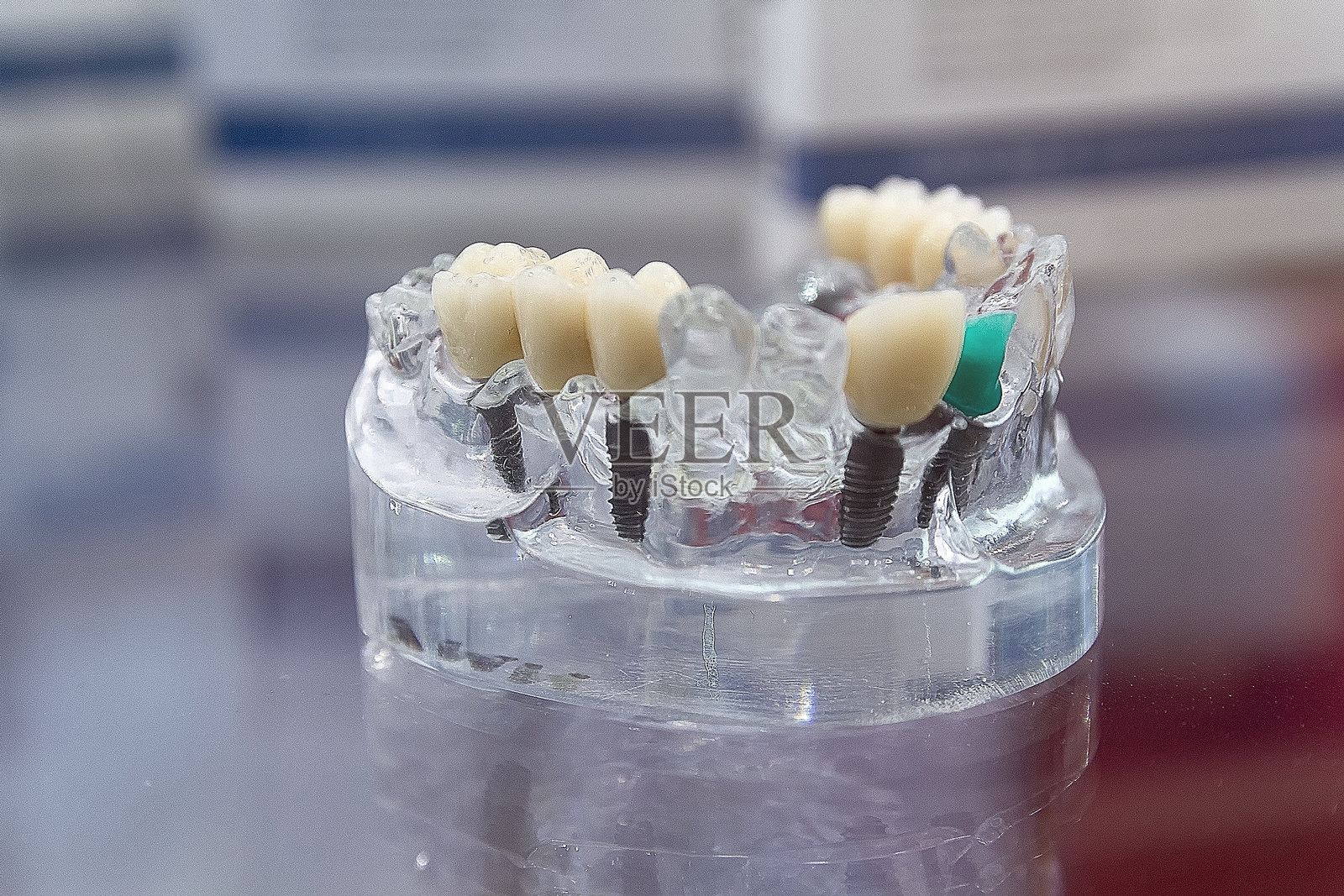 陶瓷牙齿贴面安装照片摄影图片