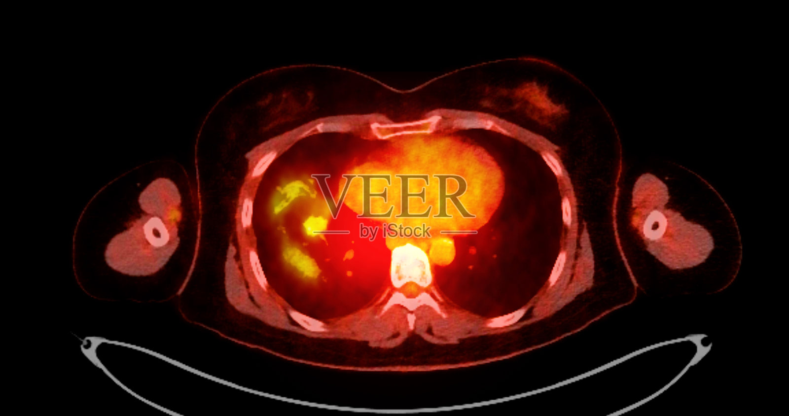 PET扫描图像显示侧面视图的全身代谢活动。适用于医学教育、诊断和细胞功能研究。照片摄影图片