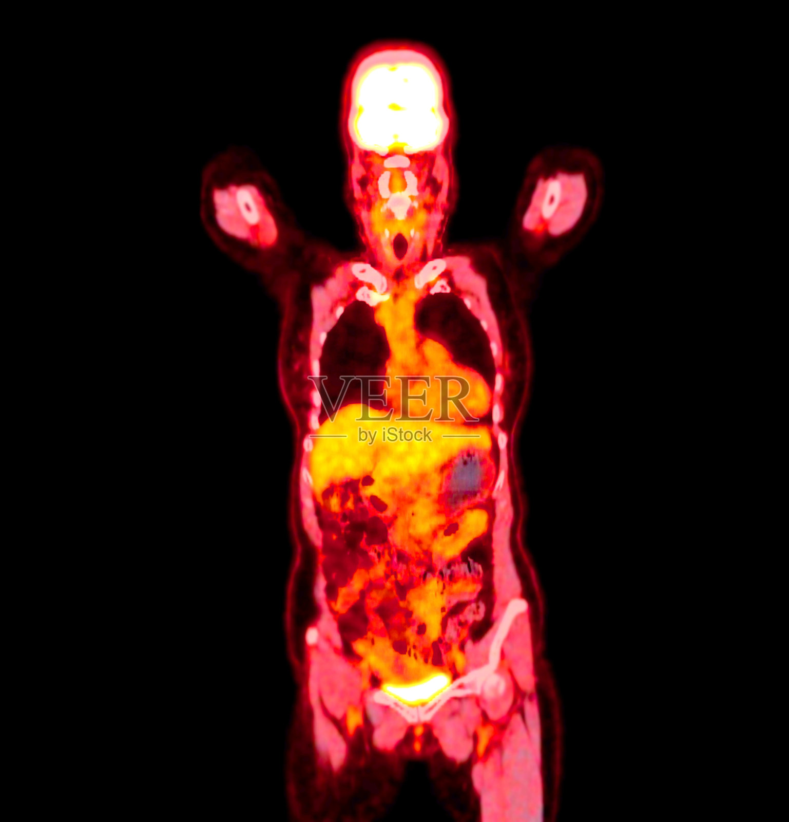PET扫描图像显示侧面视图的全身代谢活动。适用于医学教育、诊断和细胞功能研究。照片摄影图片