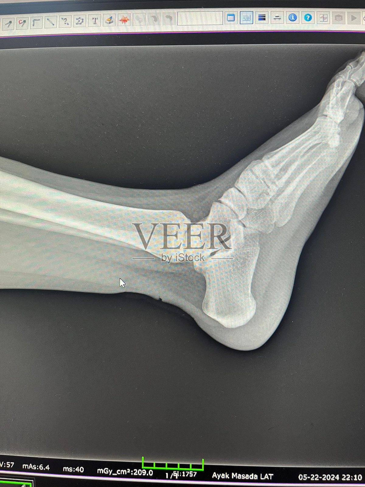 跟腱断裂的X光影像照片摄影图片