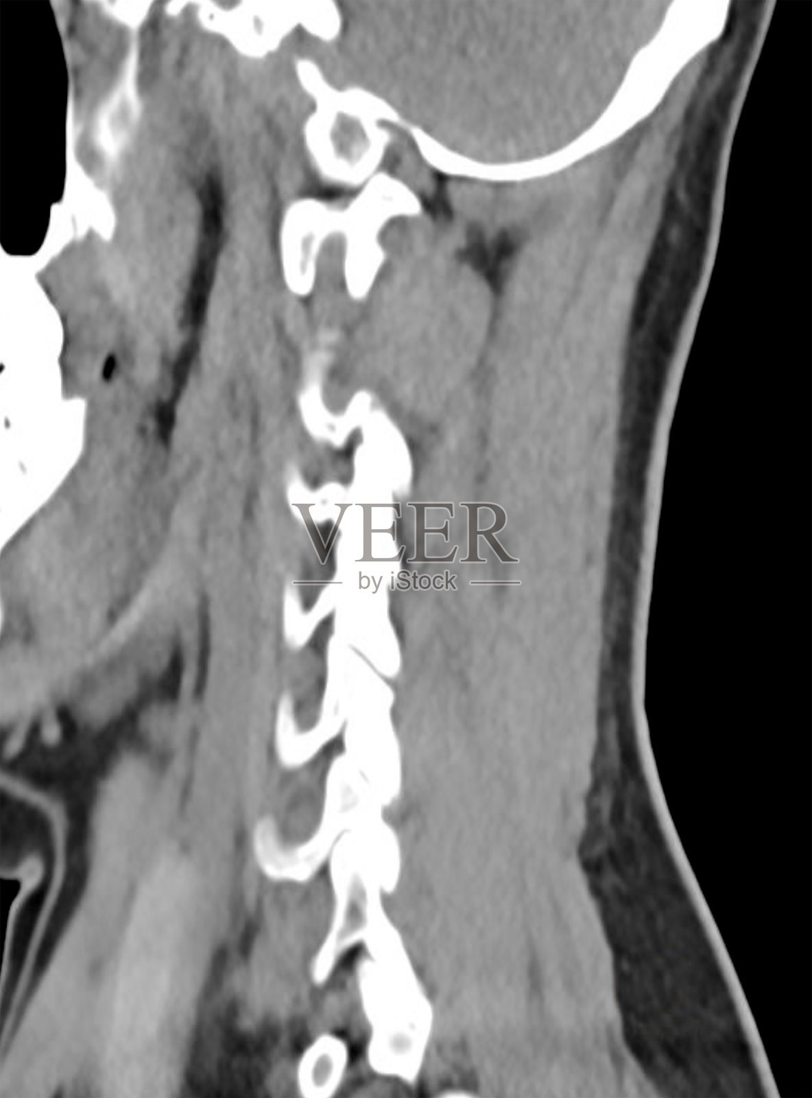 一张侧面显示男性成人颈部和脊柱的CT扫描,清晰展示肌肉和骨骼结构。照片摄影图片