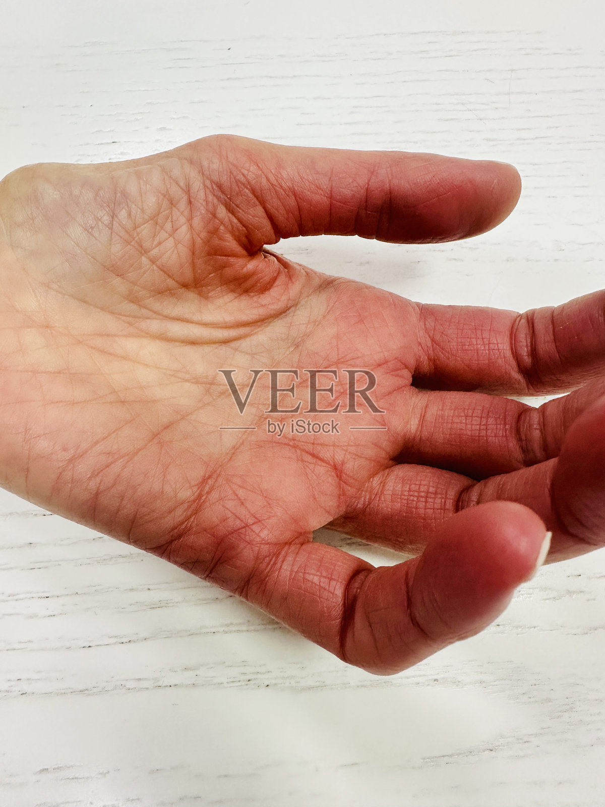 拇指的阔筋膜萎缩肌肉萎缩照片摄影图片