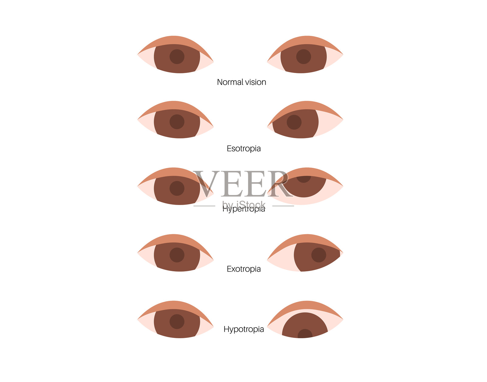 斜视眼病插画图片素材