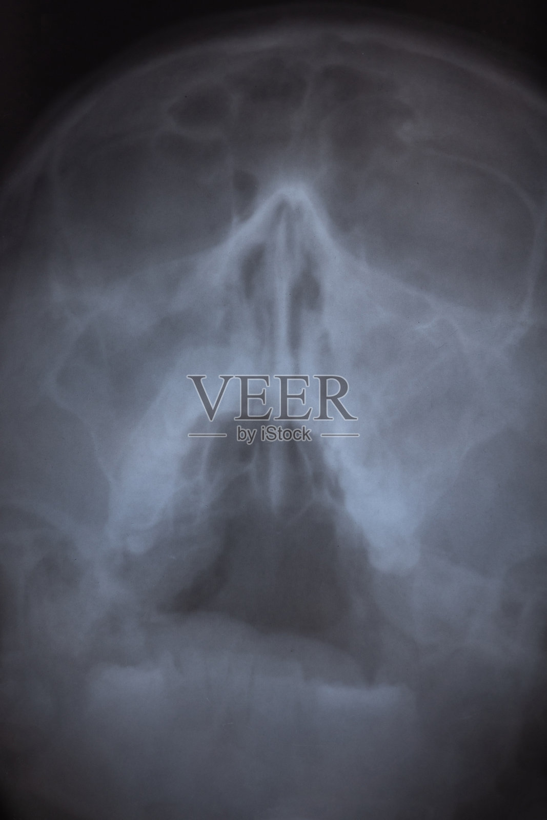 颅骨面部不对称的垂直X光扫描。头部有偏曲的鼻中隔。照片摄影图片