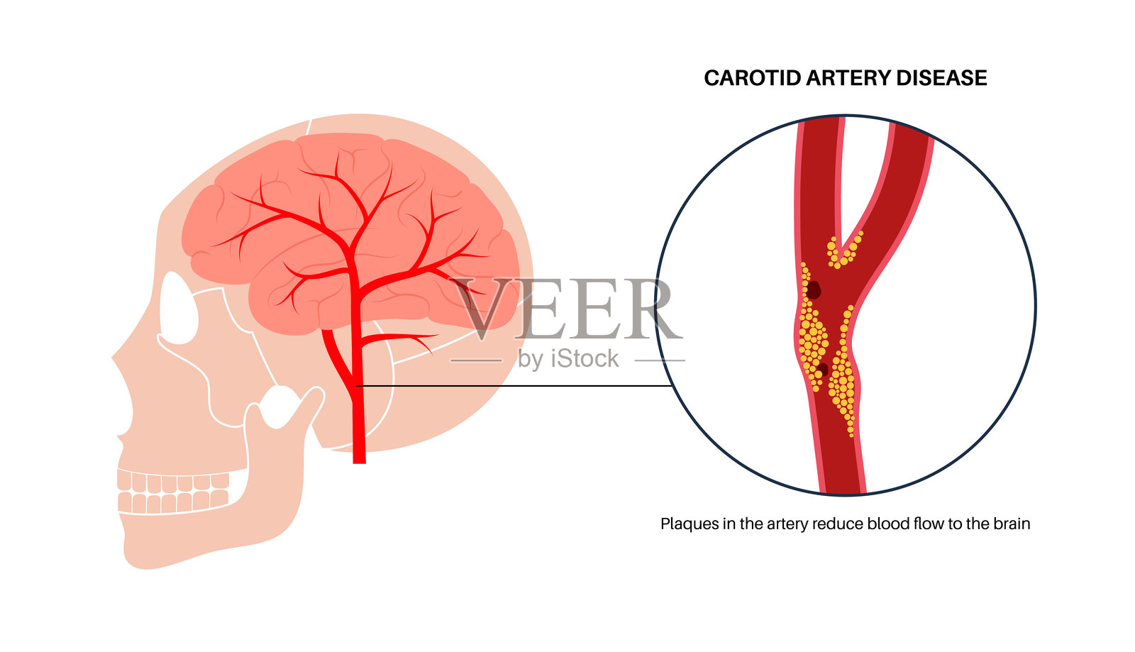 颈动脉疾病插画图片素材