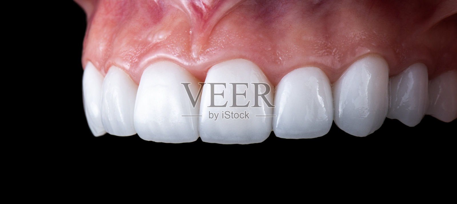 陶瓷Emax牙冠和贴面照片摄影图片