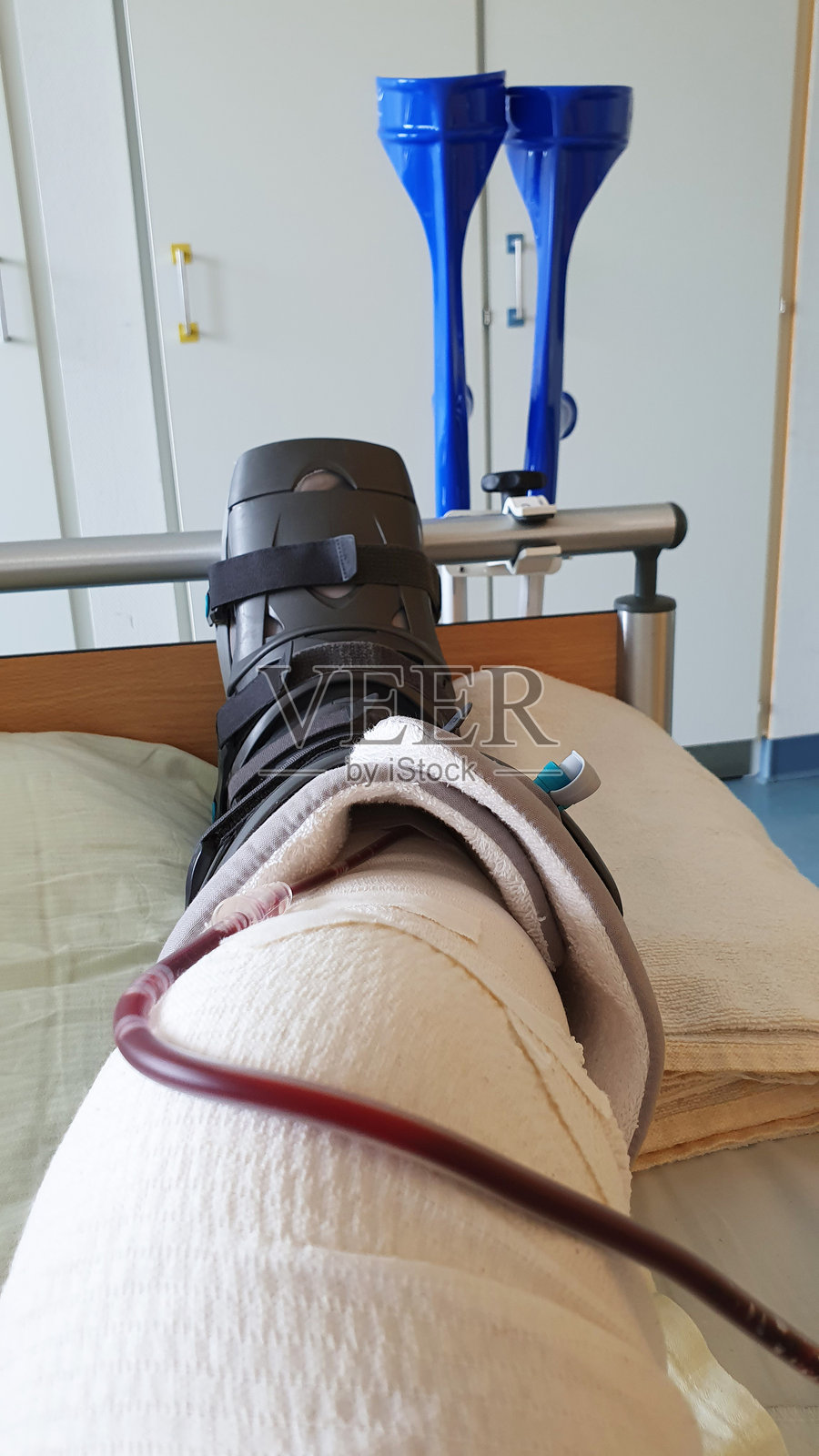 手术后,脚部使用足部矫形器进行固定。照片摄影图片