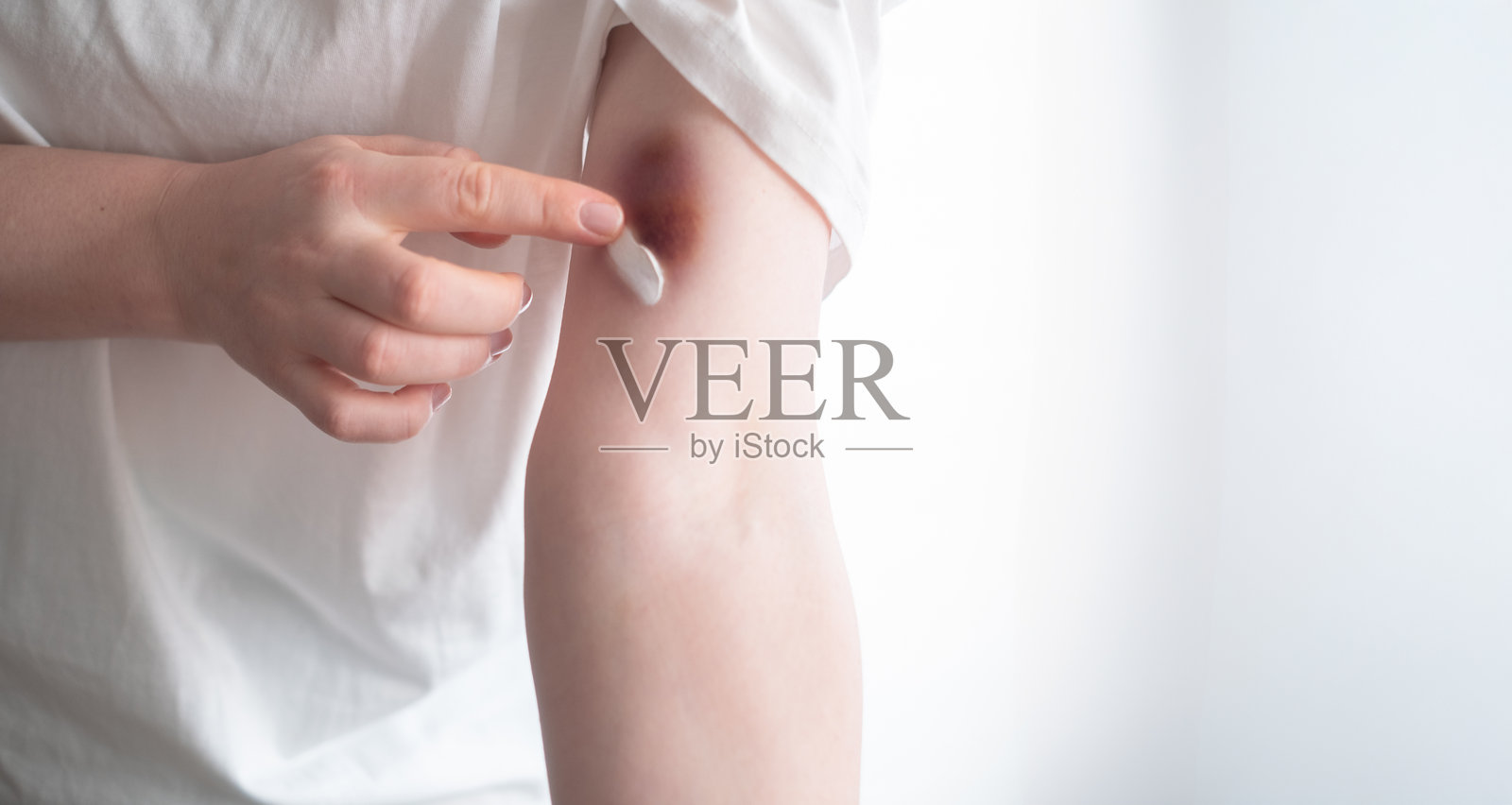 一名女性在手上的淤伤处涂抹肝素软膏以减少肿胀。受伤后的女性手部有淤血,恢复过程。照片摄影图片