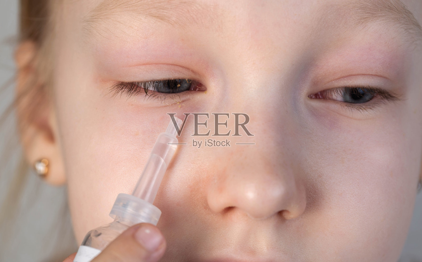 一位白人女孩手持眼药水,靠近她发炎并有脓液的眼睛。细菌和病毒感染、眼睛疼痛的疾病概念,特写镜头。照片摄影图片