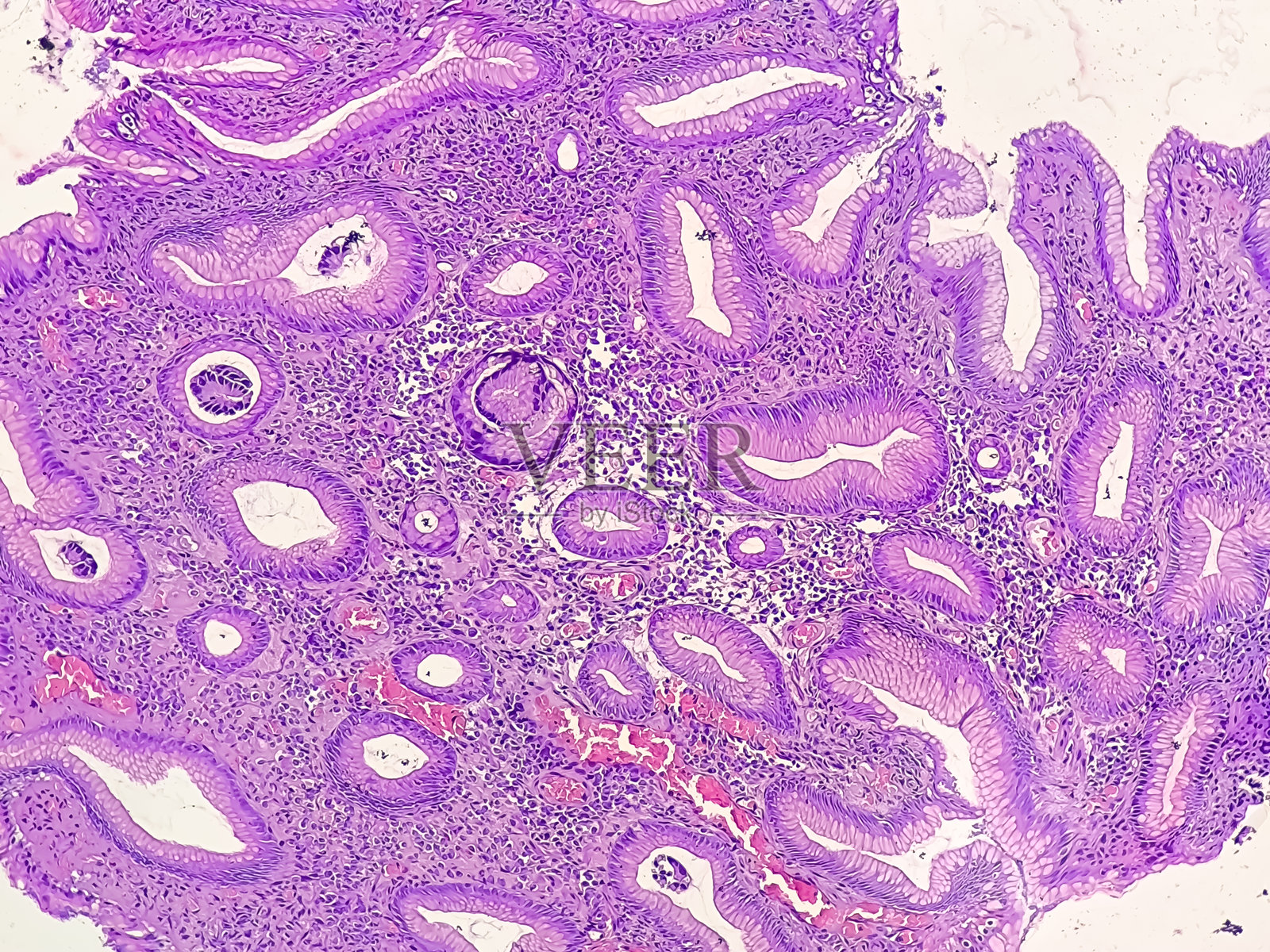 慢性活动性胃炎伴幽门螺杆菌感染。照片摄影图片