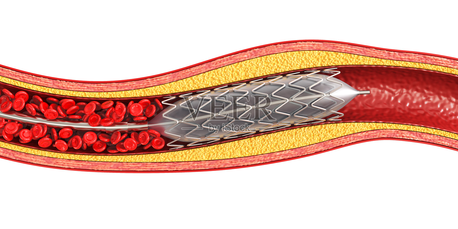 医学插图展示气球成形术和支架植入。3D插图照片摄影图片
