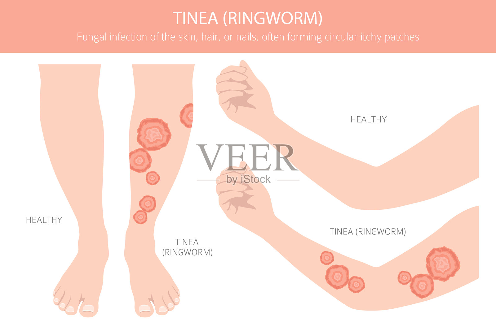 癣。环状癣。皮肤病。医学信息图设计插画图片素材