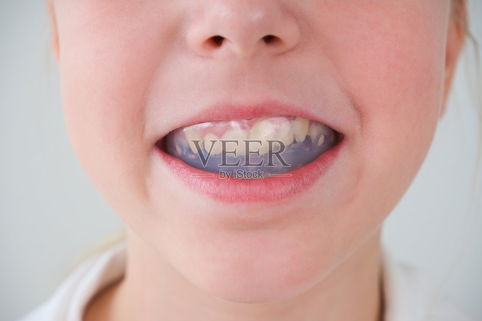 牙齿矫正模拟器。孩子的牙齿上戴着牙套。照片摄影图片