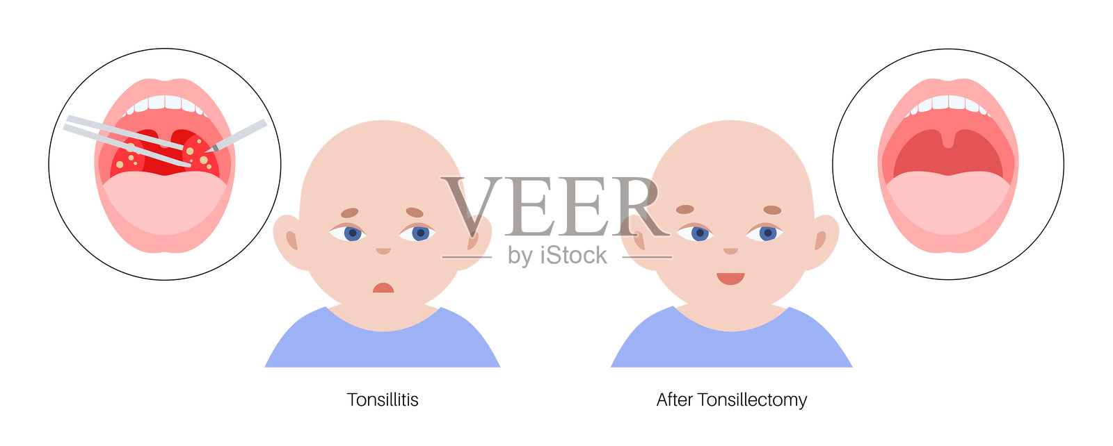 扁桃体切除术海报插画图片素材
