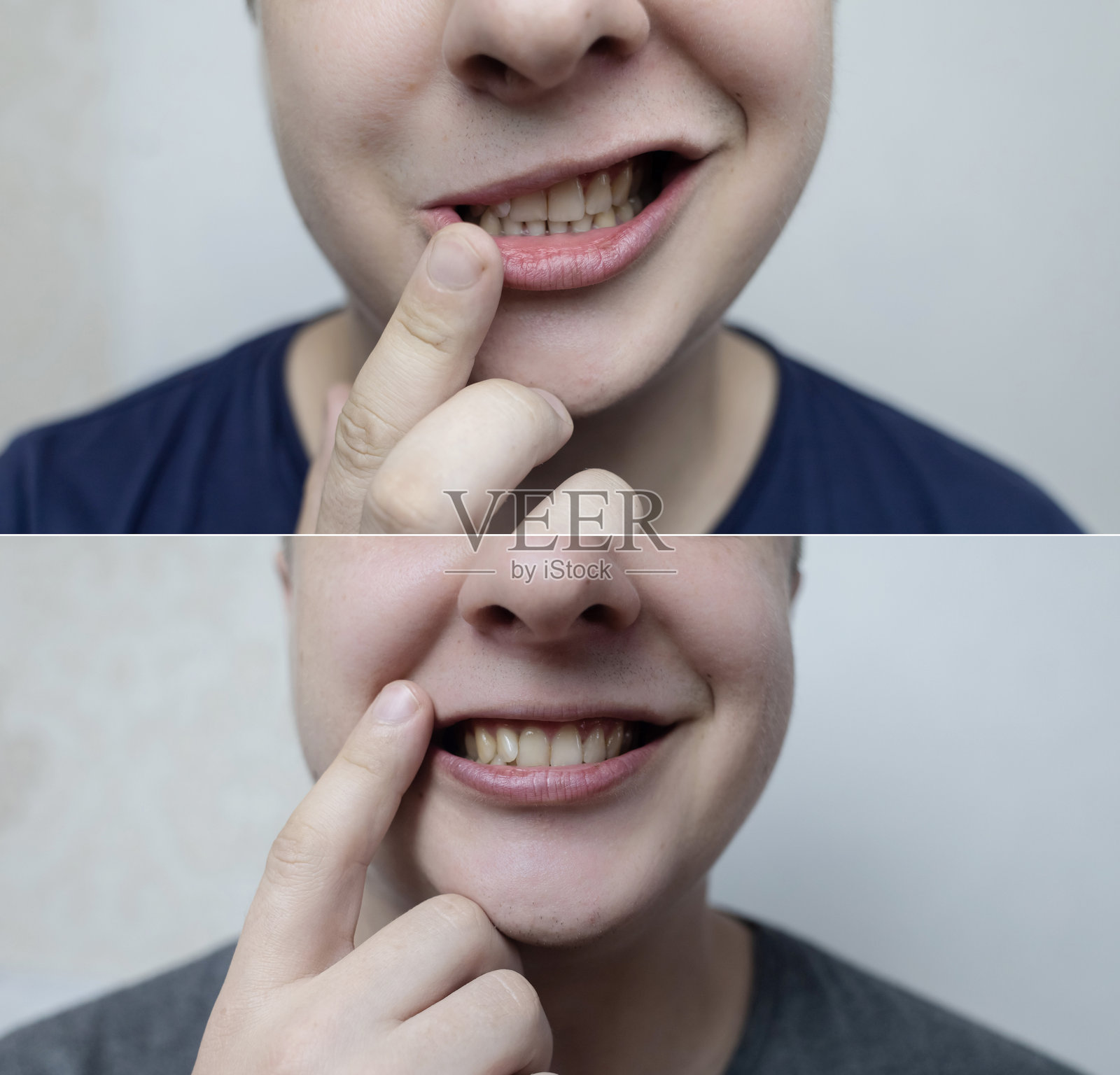 年轻人面部神经麻痹(贝尔麻痹)的前后对比。神经学、康复、治疗成功和医学的概念。照片摄影图片