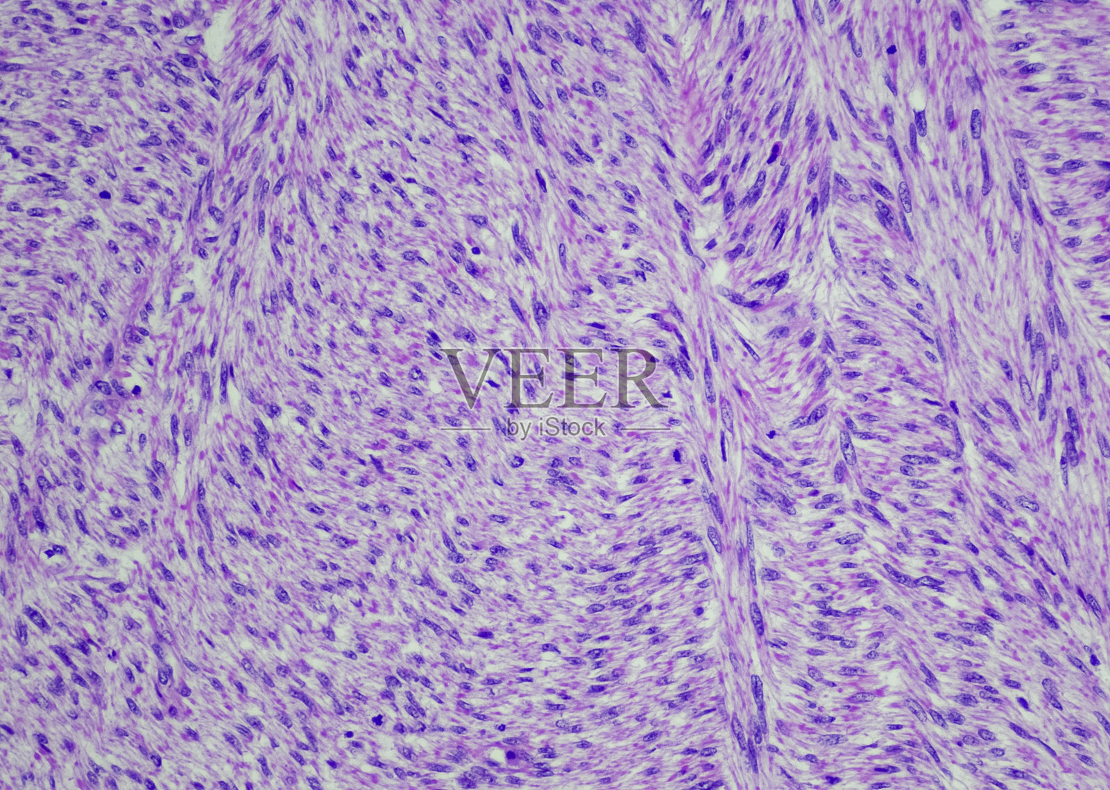 平滑肌肉瘤照片摄影图片