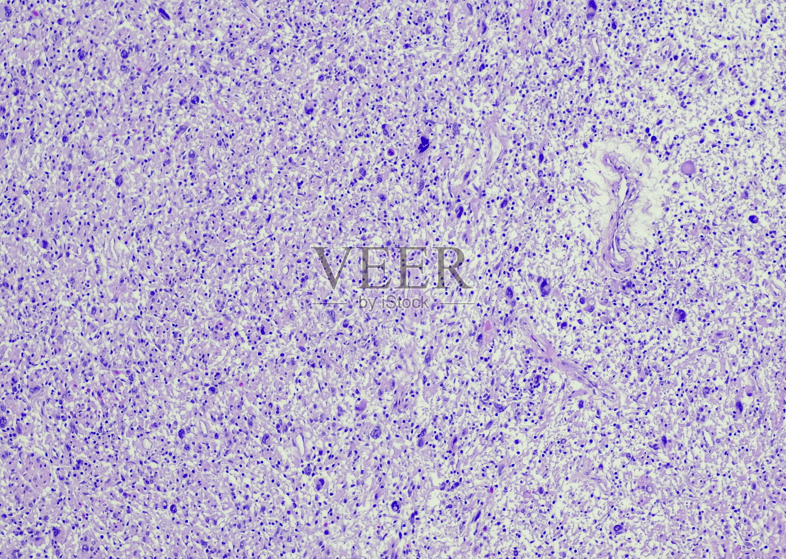 低级别恶性周围神经鞘瘤照片摄影图片