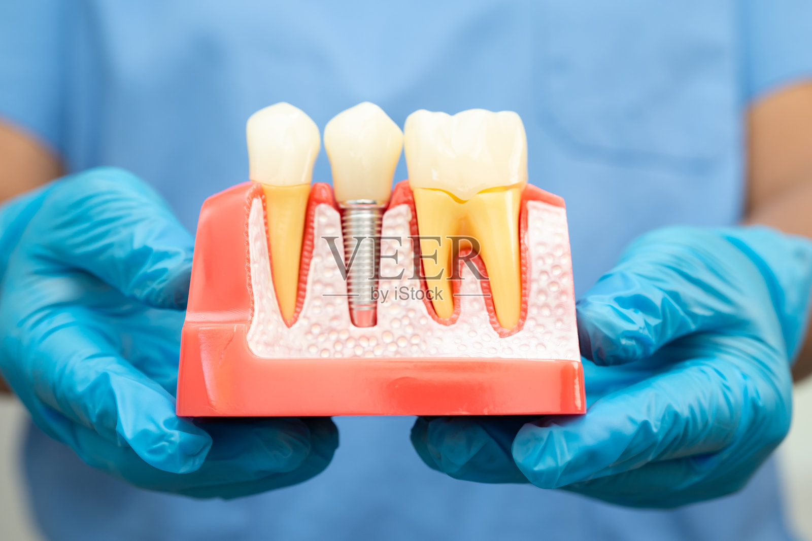 牙科植入物,人工牙根植入下颌,牙髓治疗,牙龈疾病,牙科模型供牙医研究牙科知识。照片摄影图片