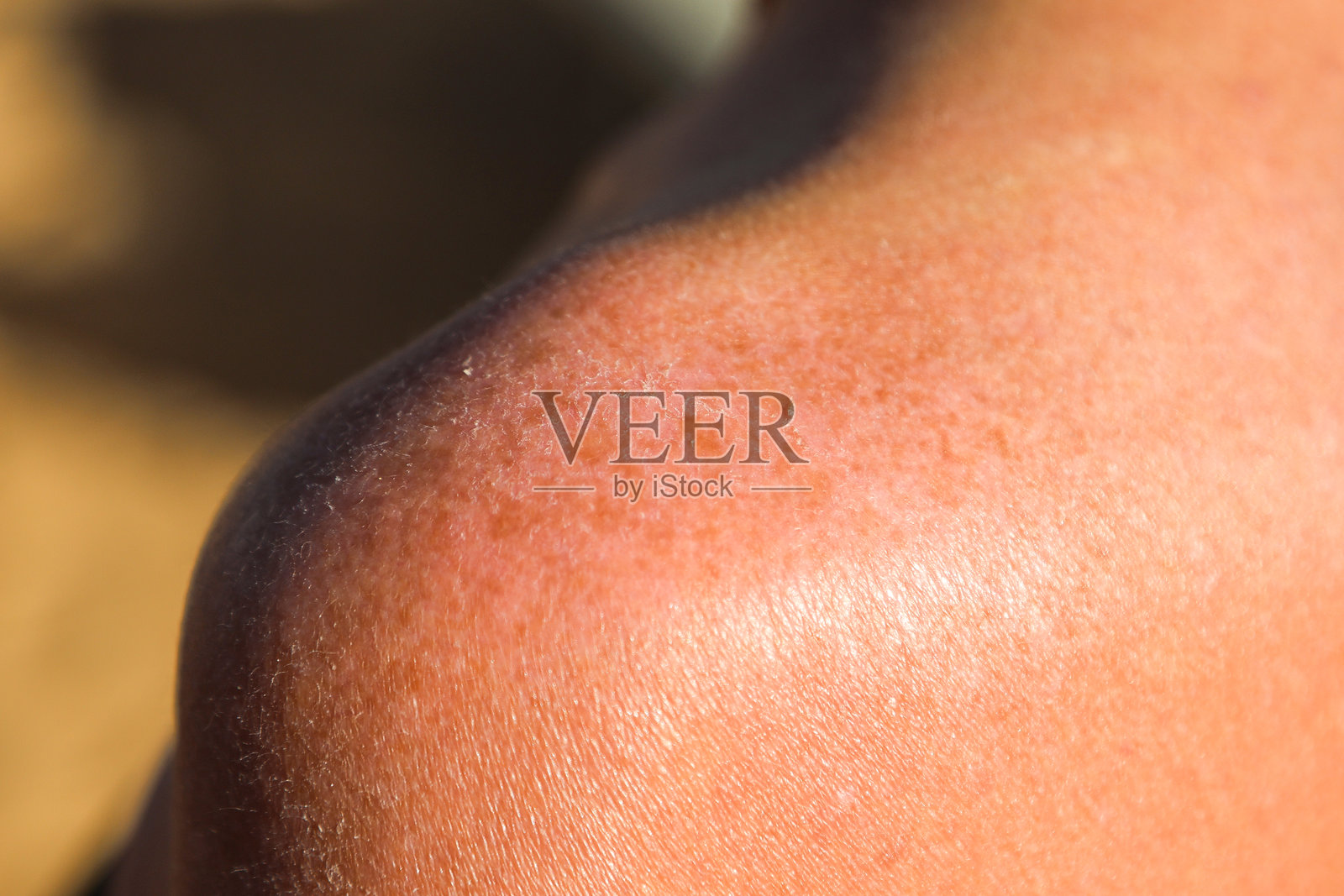 一名女子身体因晒伤而脱皮的特写,突显了过度暴露于阳光下的影响和皮肤损伤照片摄影图片