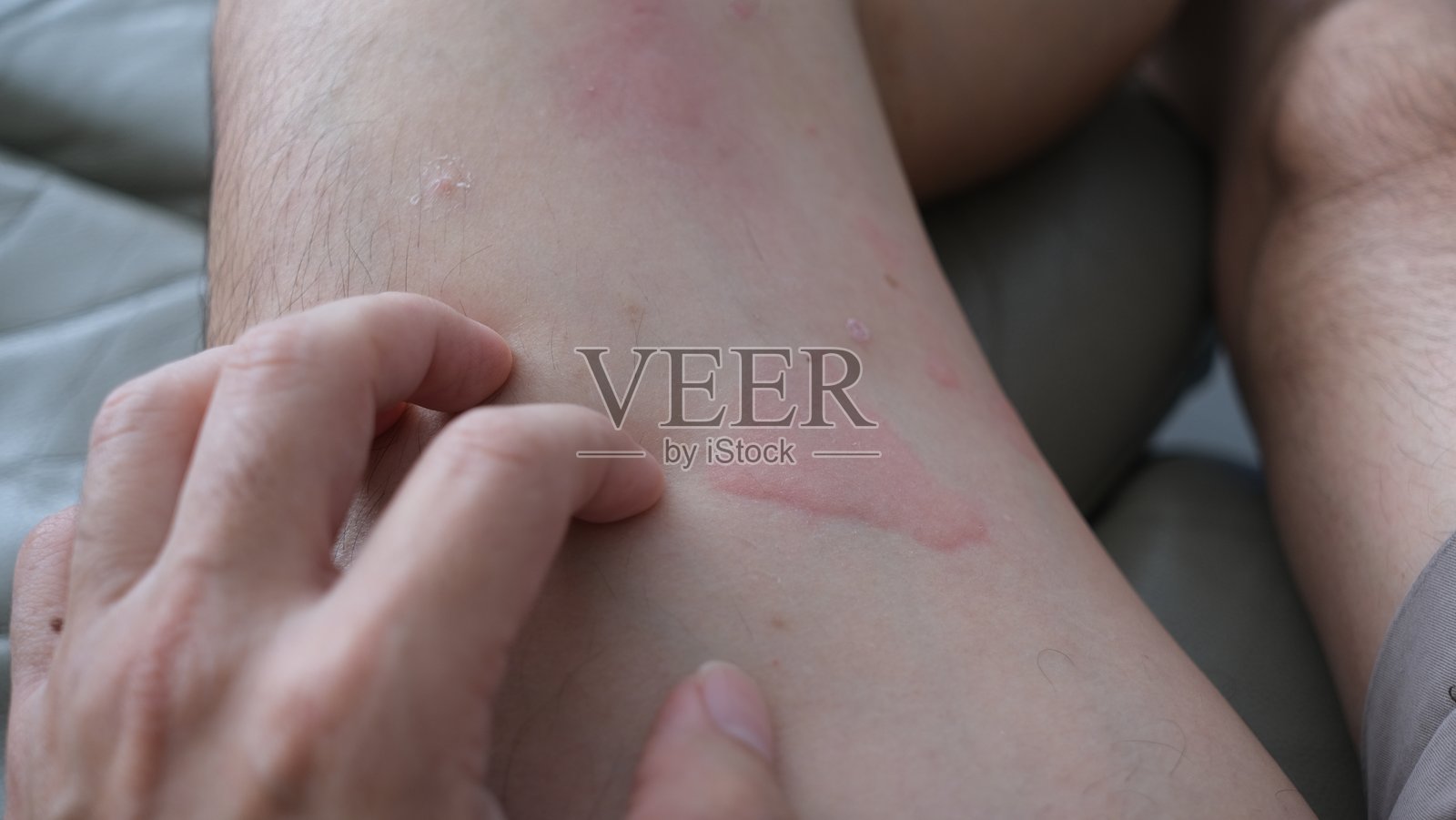 大腿皮肤出现严重荨麻疹(也称风疹块或kaligata)的特写图像。过敏症状。照片摄影图片