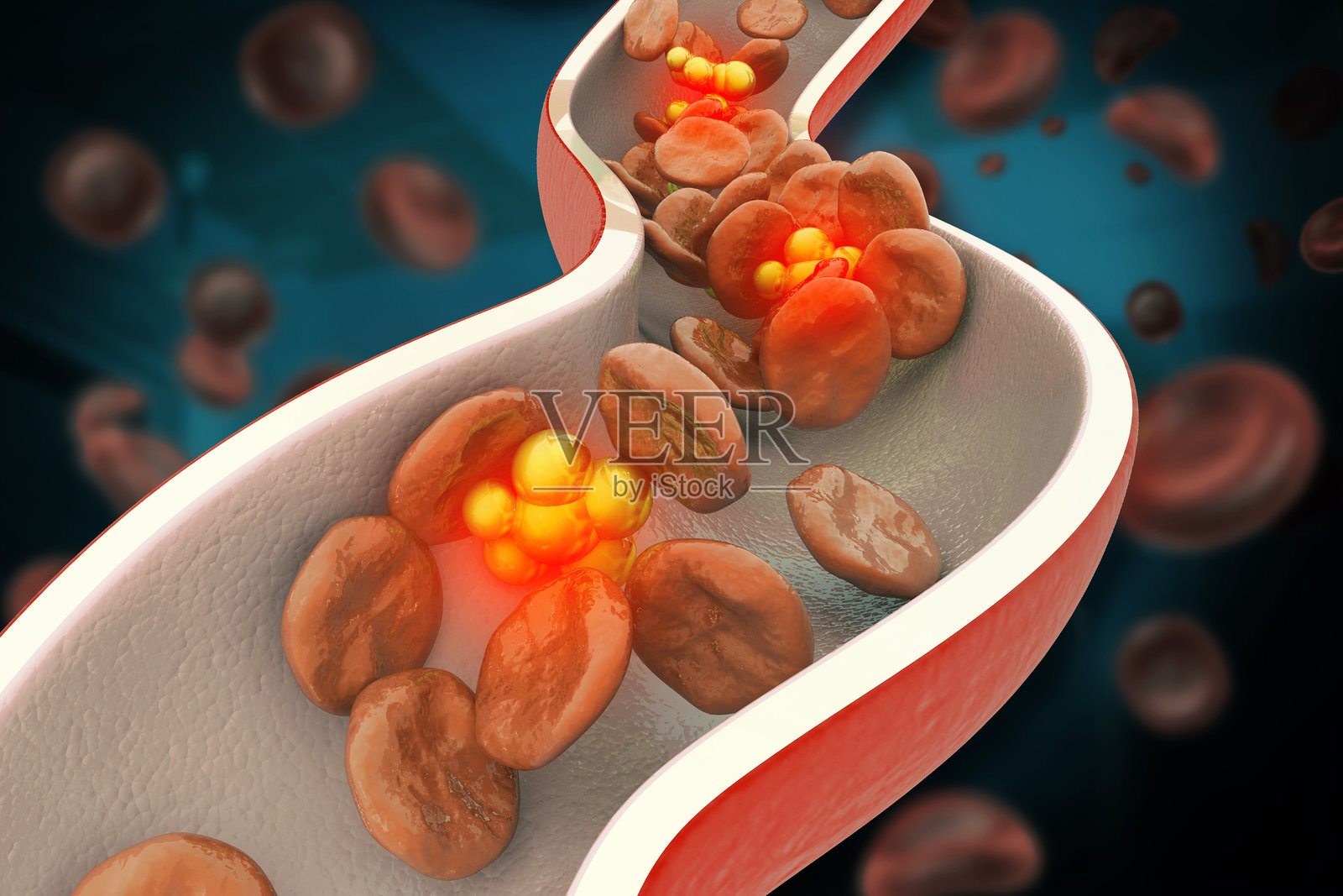 胆固醇堵塞的动脉。血液中胆固醇的堆积。3D插画照片摄影图片